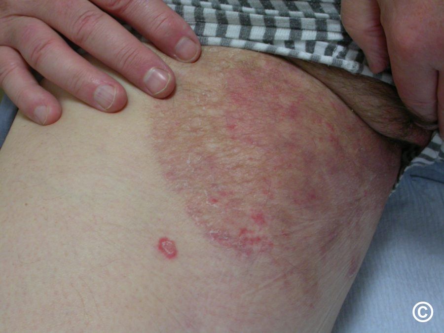 Intertrigo Symptoms, Intertrigo Rash Treatment