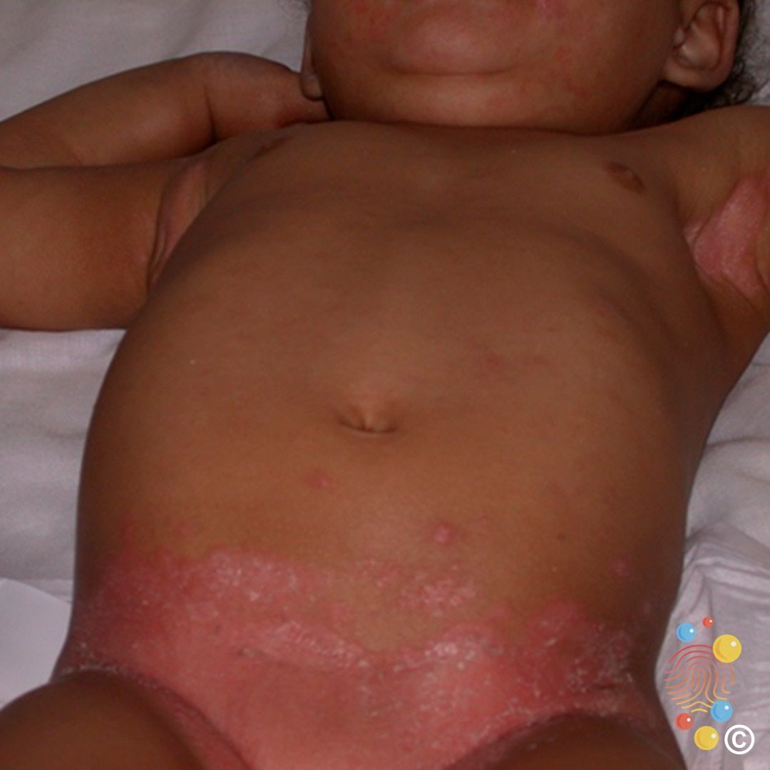 baby drool rash on stomach