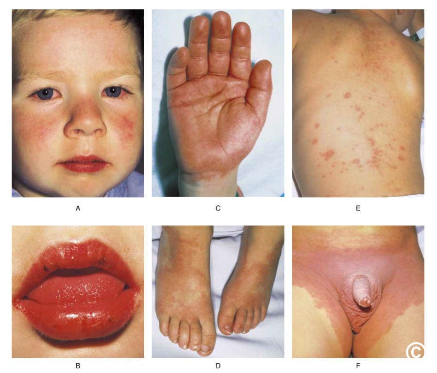 hykleri sort Tag fat Kawasaki disease