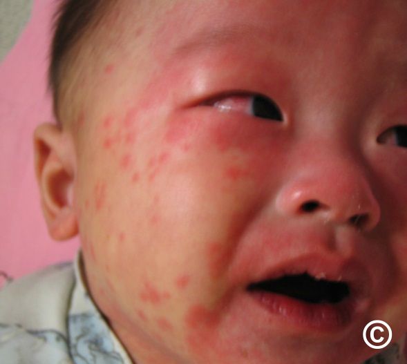 Kawasaki disease