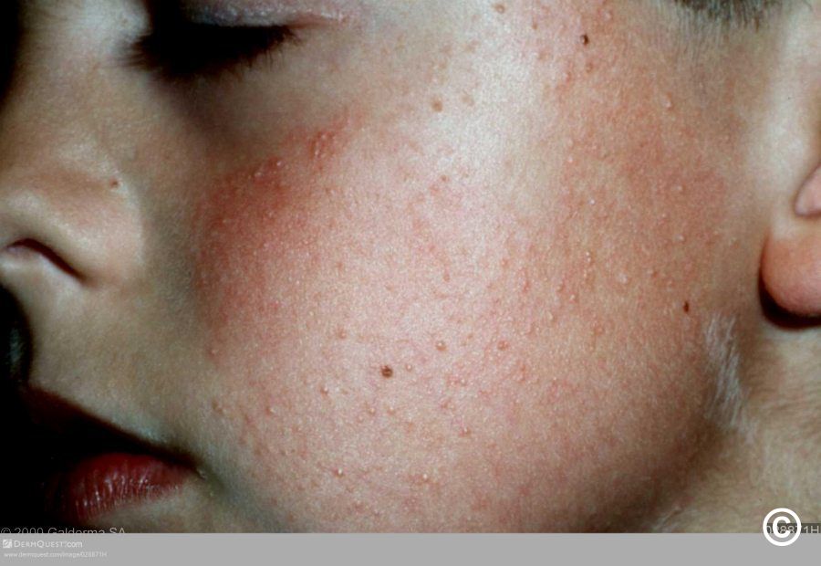 follicular hyperkeratosis face