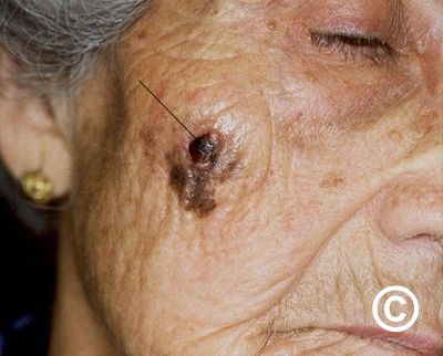 Lentigo maligna melanoma deals