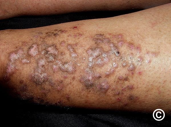 Lichen planus