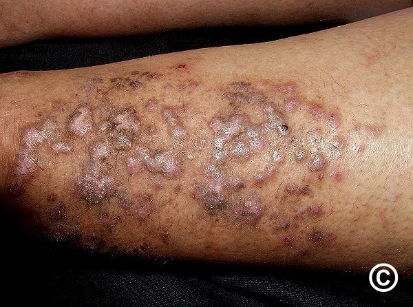 Lichen Planus - Skin Disorders - MSD Manual Consumer Version