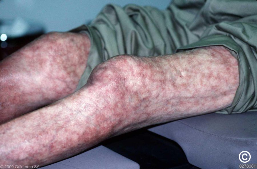 Livedo reticularis