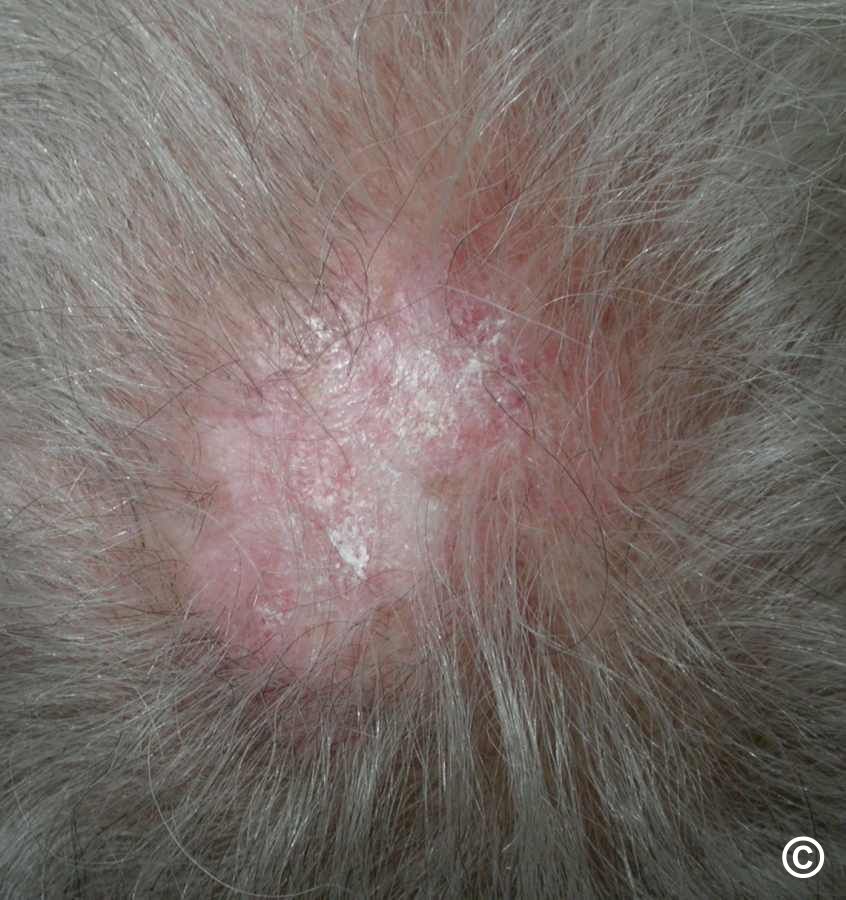 Chronic cutaneous lupus erythematosus