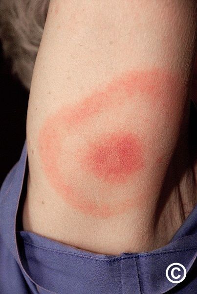 Erythema (chronicum) migrans - the cutaneous features of Lyme disease