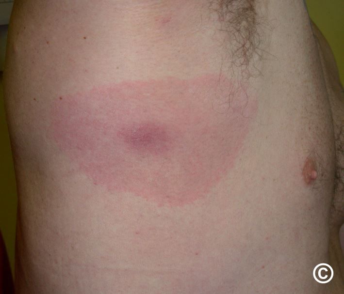 Erythema (chronicum) migrans - the cutaneous features of Lyme disease