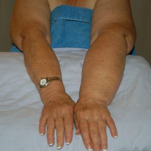 Lymphoedema