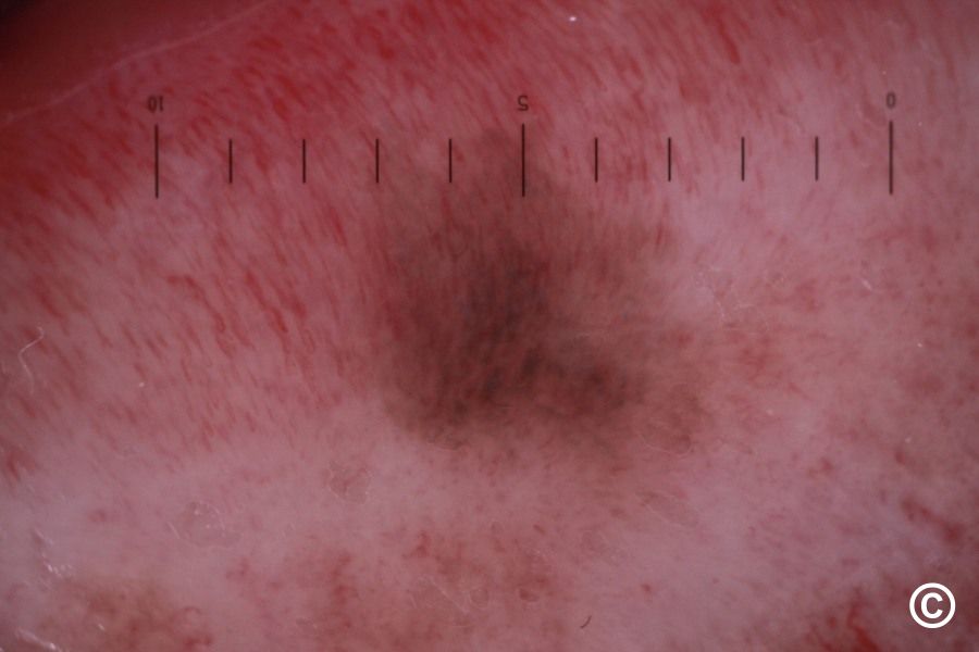 Mucosal melanocytic macules