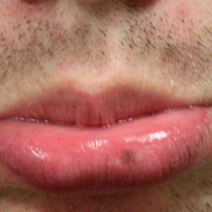 Mucosal melanocytic macules