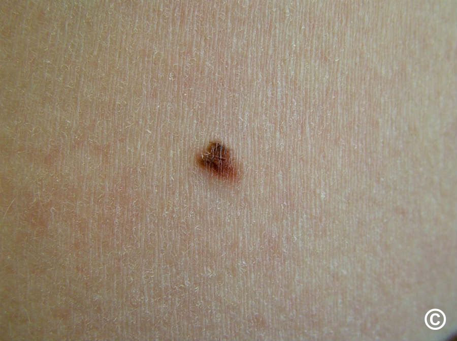 Early Malignant Melanoma In Situ