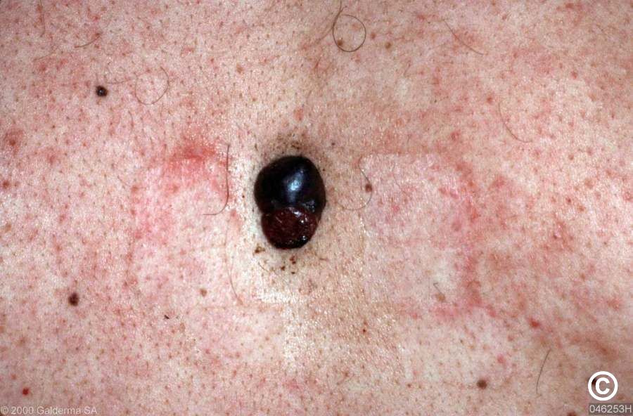 superficial spreading malignant melanoma