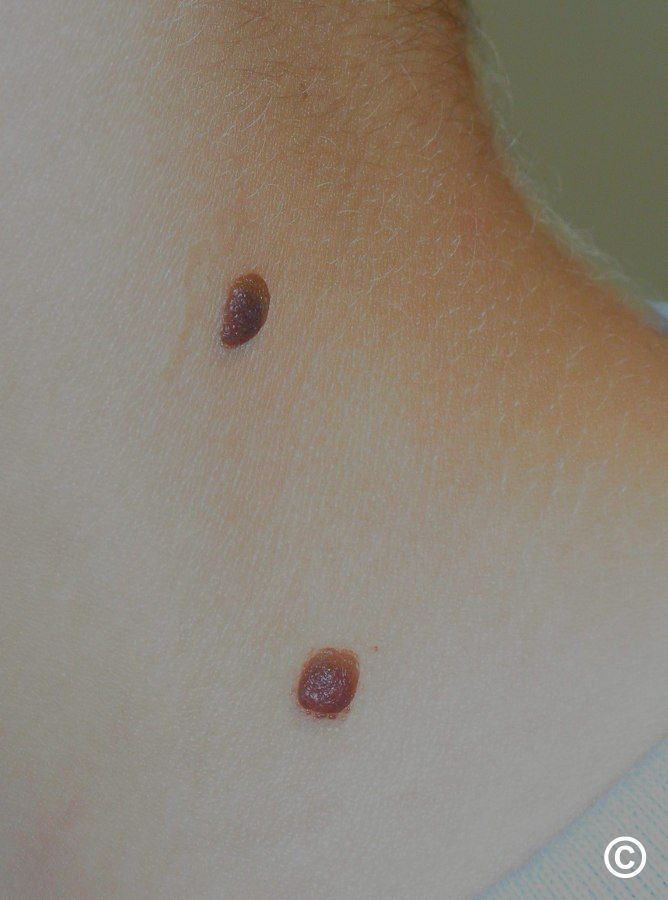 Benign melanocytic naevi