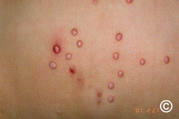Molluscum treatment store