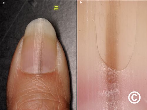 Nail disorders Nail disorders