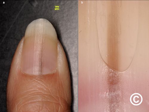 Horizontal Ridges in Nails FAQ & Tips - The Dermatology Specialists