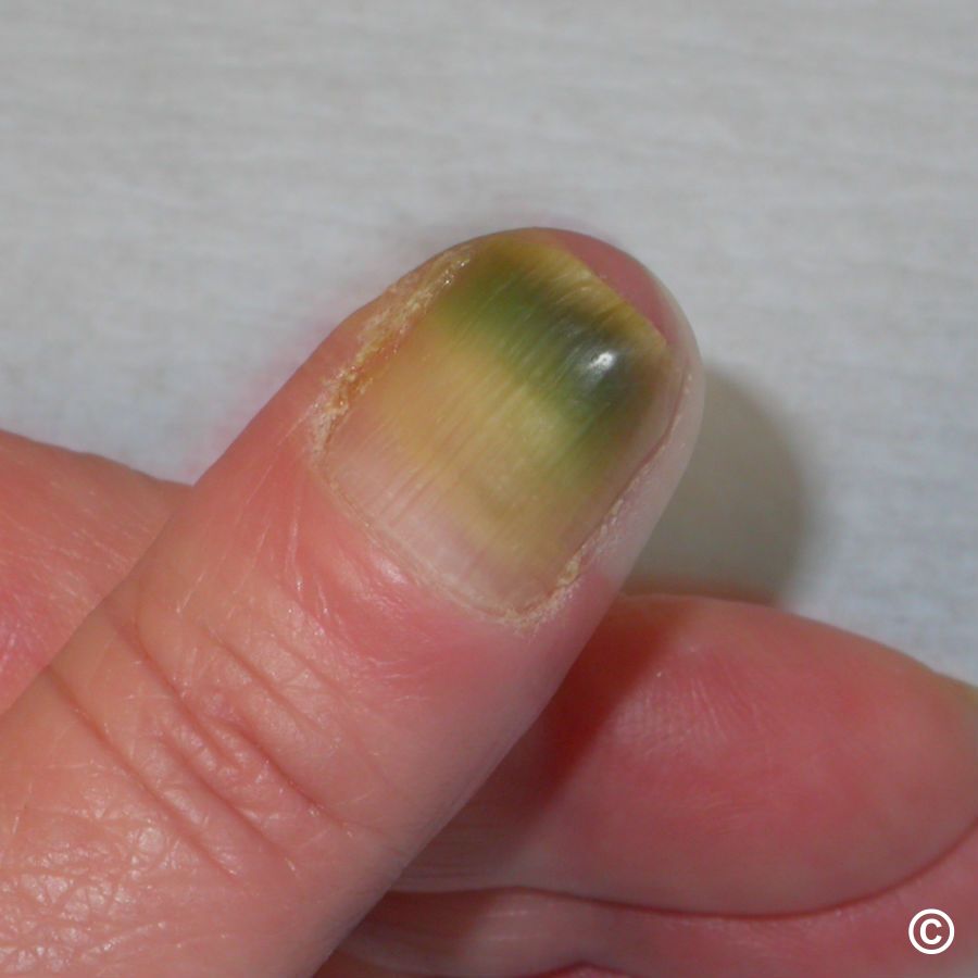 Nail Infections Caused By Fungi Such As Onychomycosis Also Known As Tinea  Unguium Thumb Infection Caused By Dermatophytes And Yeasts And For The  Concomitant Antibacterial Activity Stock Photo - Download Image Now -