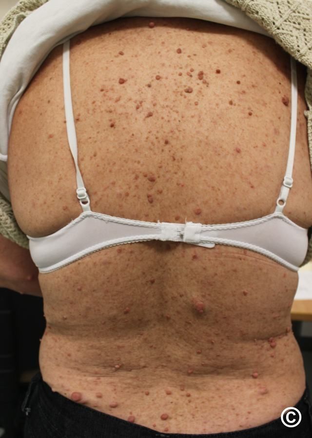 neurofibromatosis glutathione This isn't just skin bumps this is what happens when a genetic condition  turns nerve tissue into tumors. What you're seeing is severe  neurofibromatosis type 1 (NF1)  a disorder where the