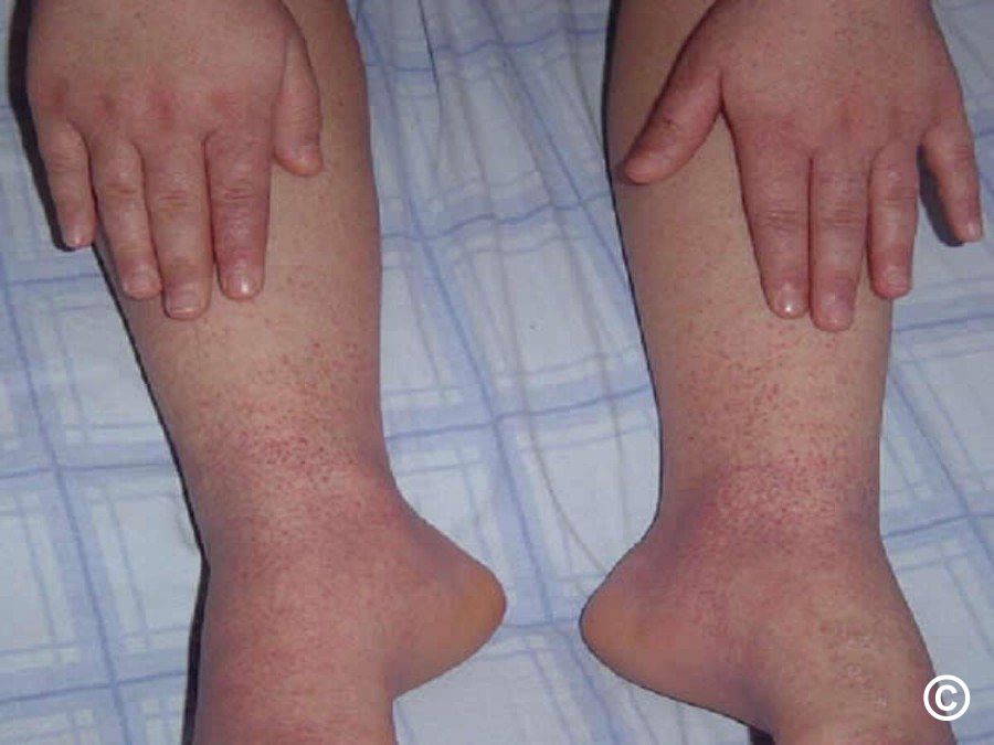 Papularpurpuric gloves and socks syndrome (PPGSS)