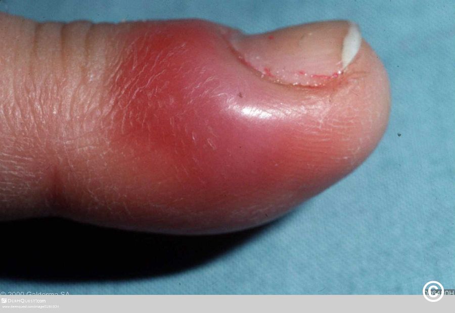 Pseudomonas bacterial nail infection. Close-up of the thumb nail on the  right hand of a 59-year-old woman with green nail syndrome (chloronychia).  Thi Stock Photo - Alamy