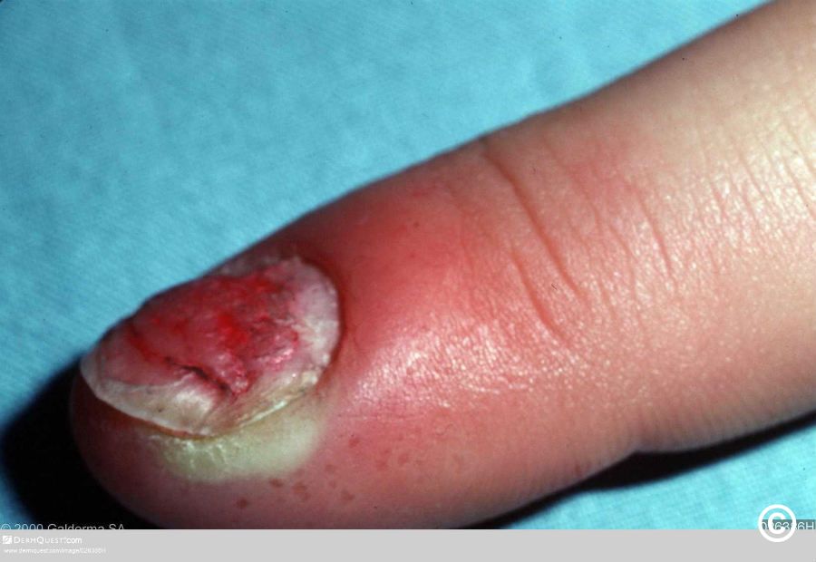 Nails: Infections, anemia, psoriasis: What nails can reveal about your  health - The Economic Times