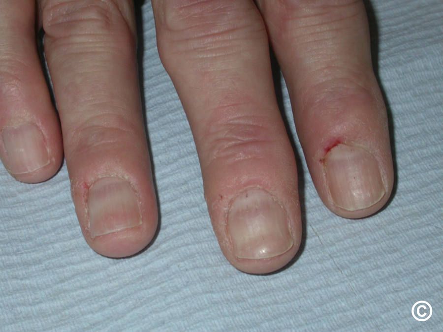 Green nail syndrome - Wikipedia