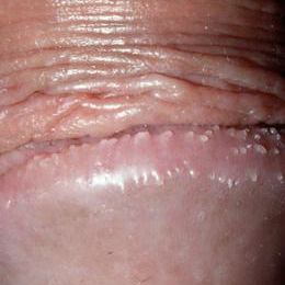 Pearly penile papules
