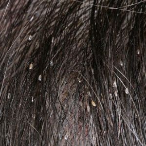 Head lice (syn. pediculosis capitis)