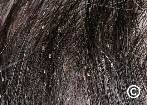 Head lice (syn. pediculosis capitis)