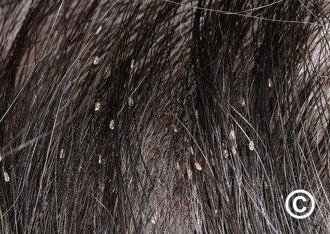 Head lice Pediculosis capitis  DermNet