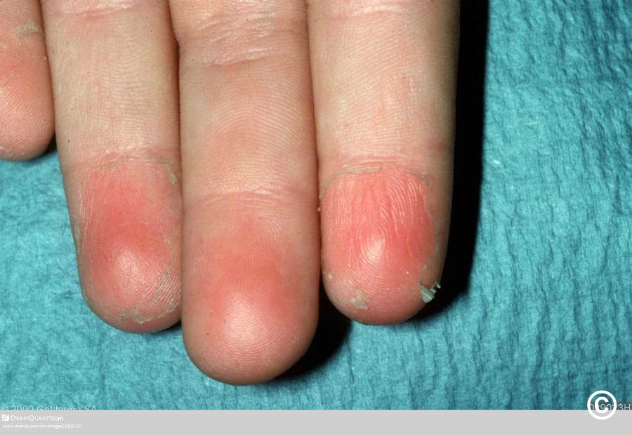 Causes of Skin Peeling on Fingernails