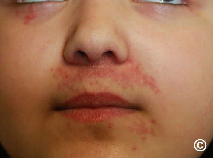 Perioral dermatitis