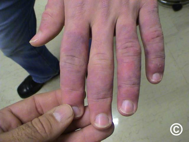 Perniosis chilblains