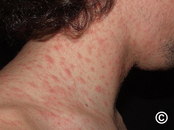 Pityriasis Rosea Pityriasis Rosea
