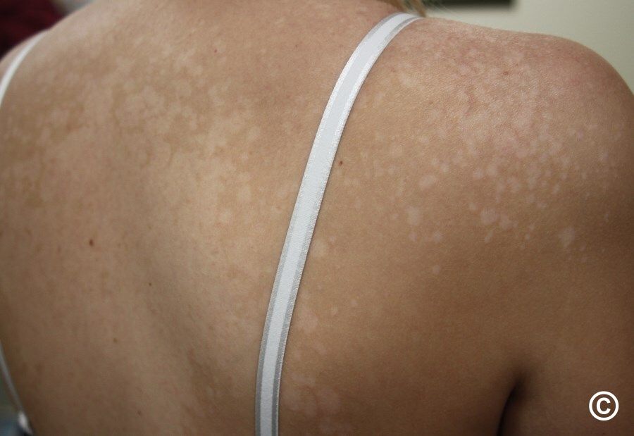 Pityriasis versicolor