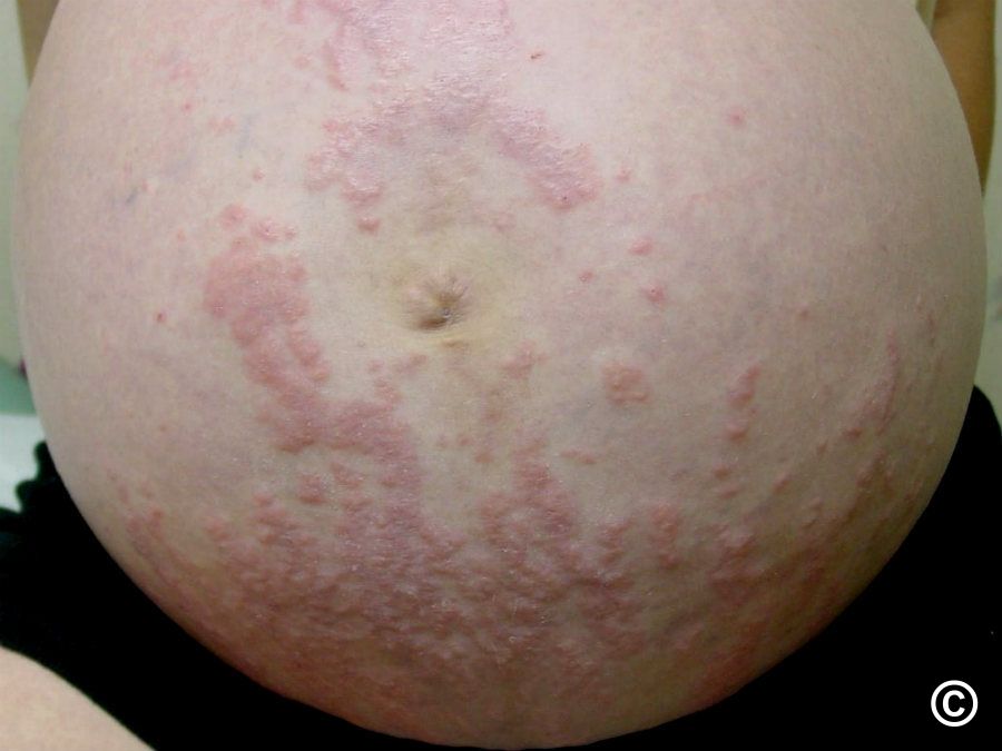 Polymorphous eruption of pregnancy