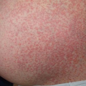 7 types of pregnancy rash: Symptoms and what they look like