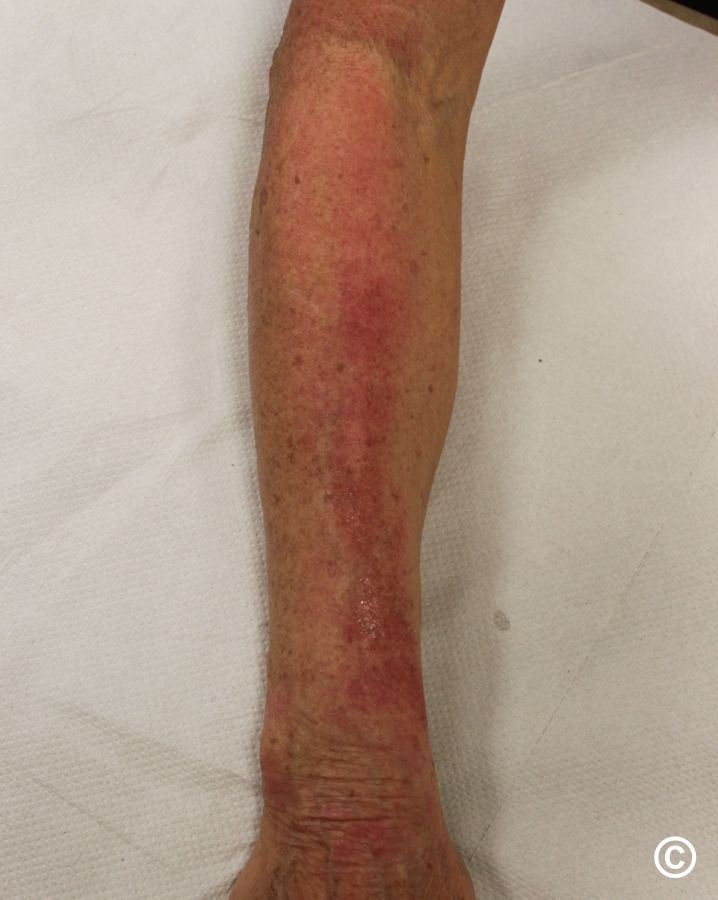 Brachioradial pruritus