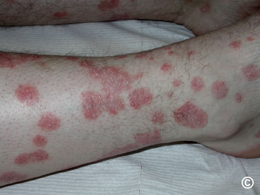 Plaque Psoriasis On Legs