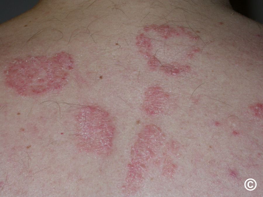 Psoriasis