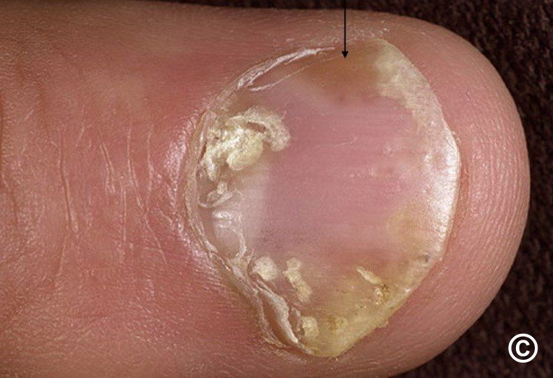 Nail psoriasis - AllergyKB