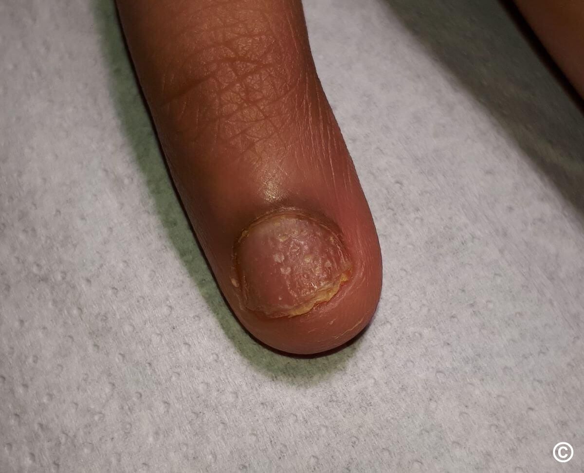 This Man's Pitted Nails Turned Out to Be a Chronic Skin Condition