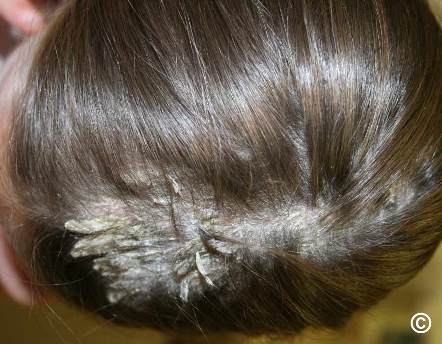 Psoriasis: scalp psoriasis
