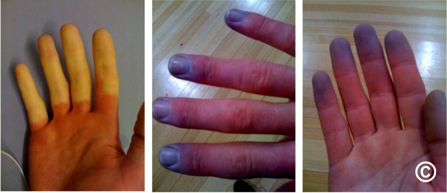 Raynaud's phenomenon