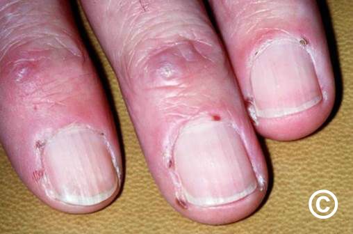 Nails in Systemic Disease | SpringerLink