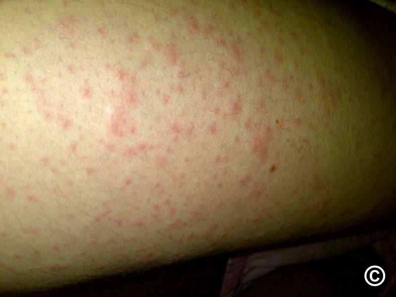 Rheumatoid arthritis (RA) and Still's disease