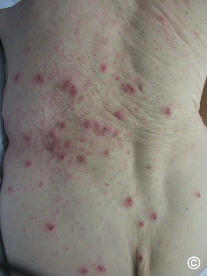 Scabies blisters discount