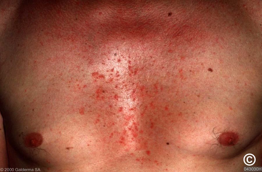 Seborrhoeic eczema