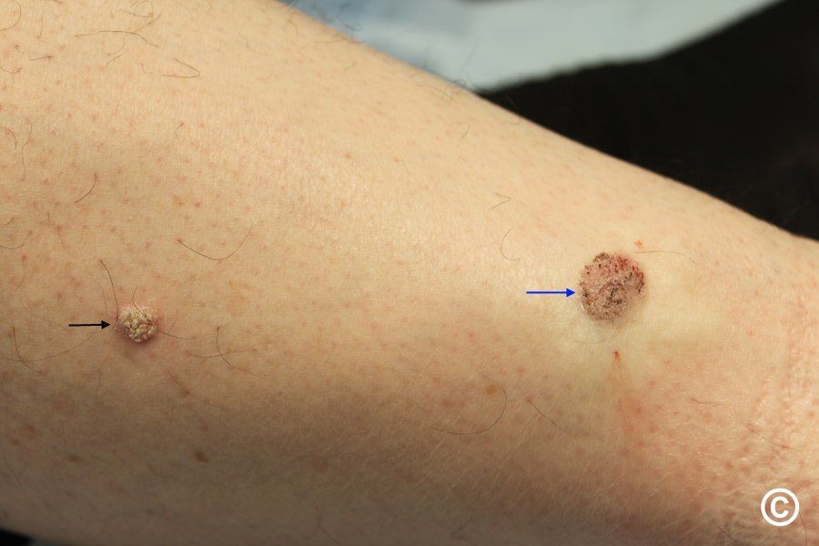 Verrucous keratosis